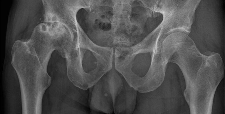 Artrose deformante da articulación da cadeira na radiografía