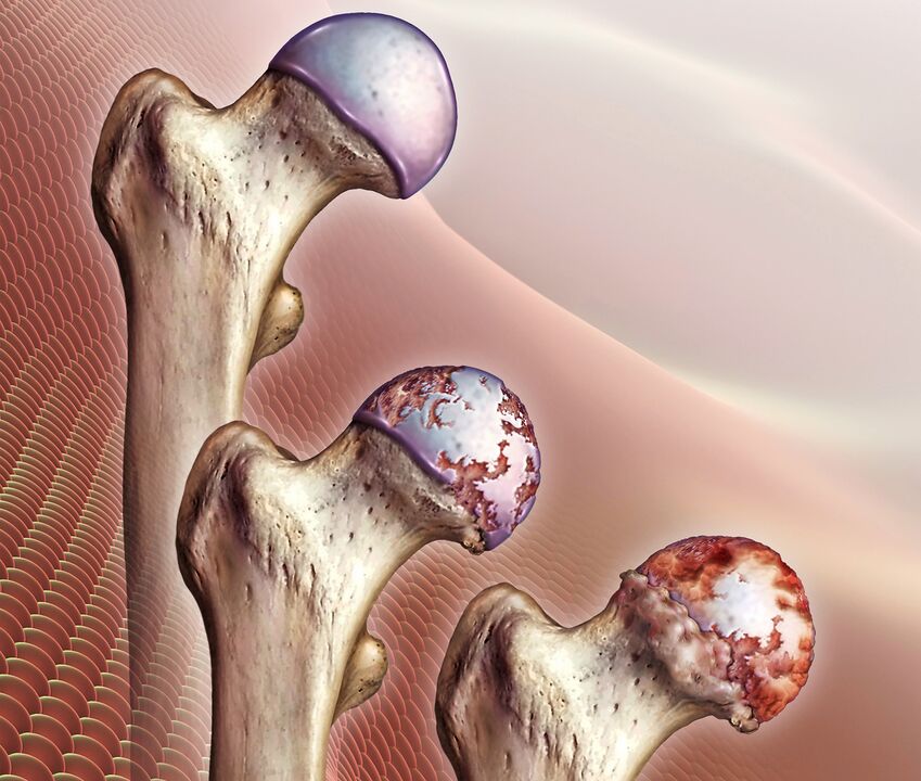 O desenvolvemento da artrose da articulación da cadeira