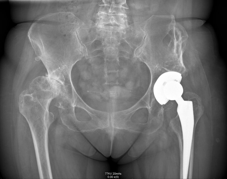 Radiografía da articulación da cadeira despois da artroplastia