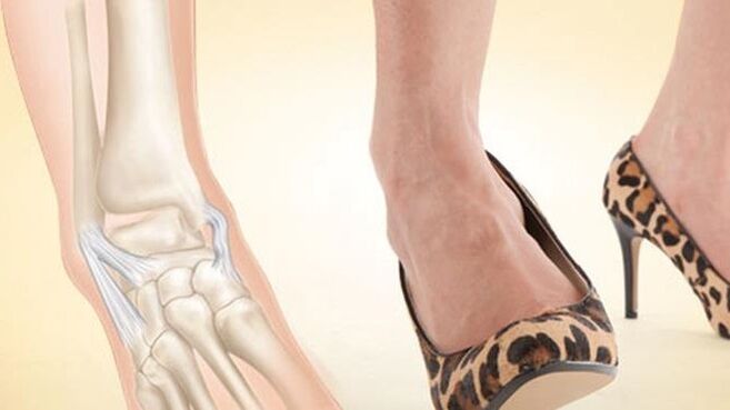 usar zapatos con tacóns como causa de artrose do nocello